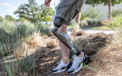 Advanced Prosthetics Prosthetic Services
